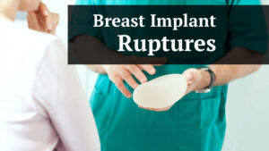 breast implant ruptures