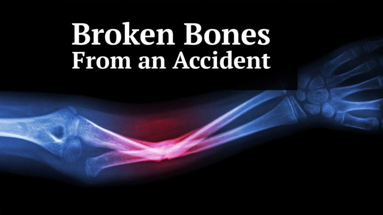 broken bones from an accident
