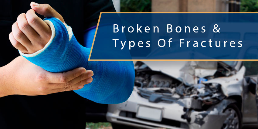 Common Broken Bones and Types of Fractures From Motor Vehicle Collisions